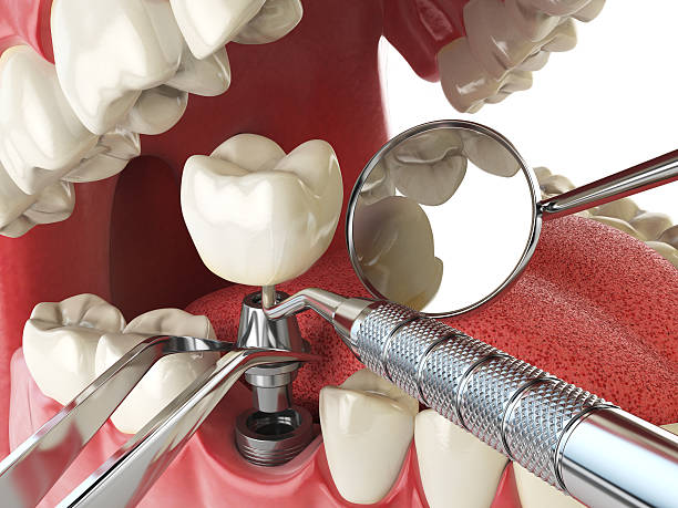 Best Knocked-Out Tooth Emergency  in Highland, CA